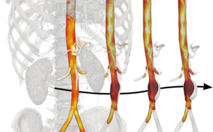 Figure 1. Mechanically and hemodynamically-driven growth and remodeling models of disease progression could help improving clinical decision-making providing both short and long-term indications on the future course of disease.